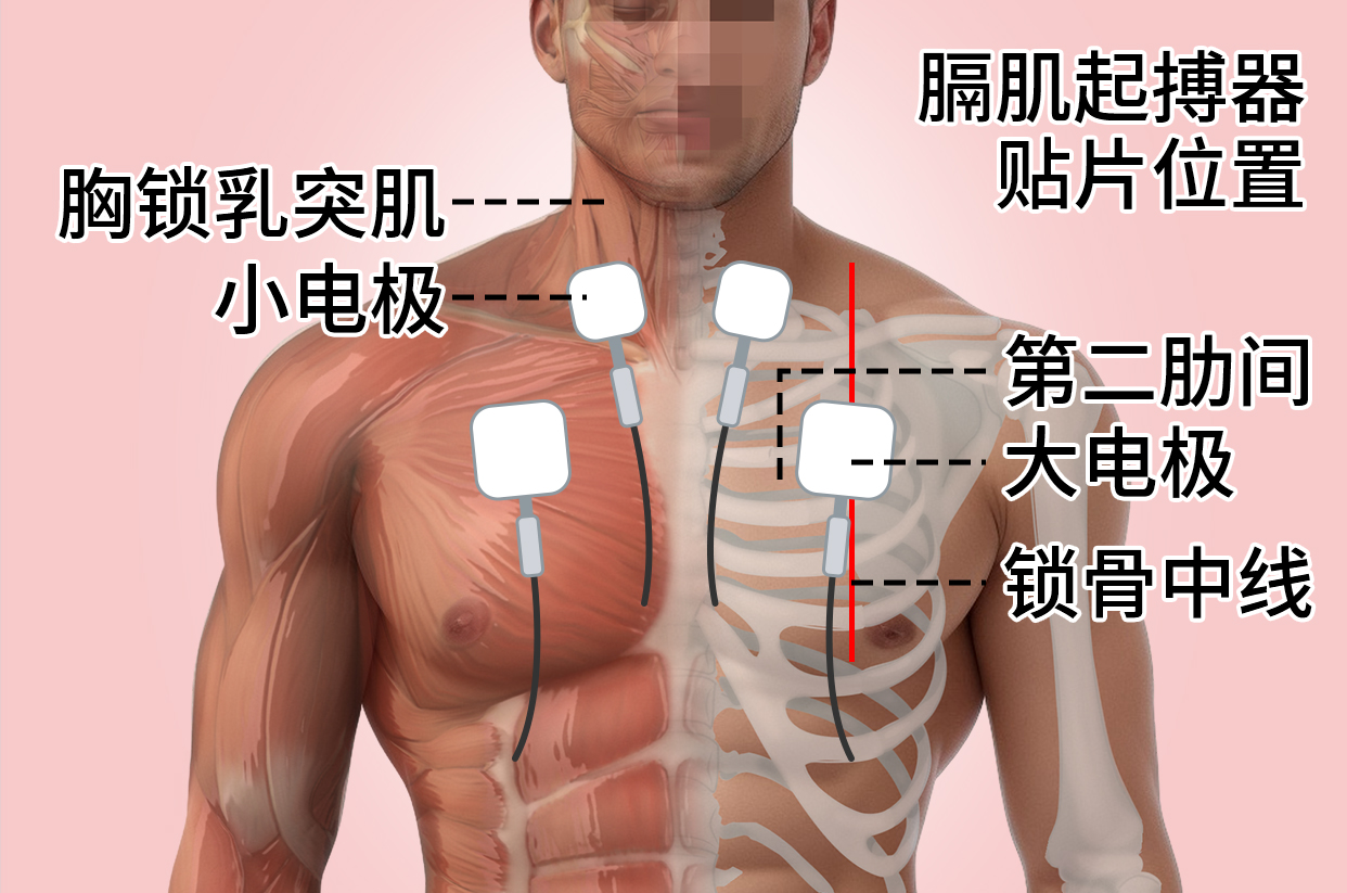 膈肌貼片貼哪個(gè)位置.jpg